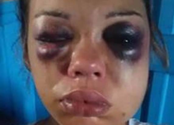Ele fugiu com as duas filhas do casal; O rosto dela ficou desfigurado